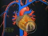 Reverse Heart Disease Naturally Nitric Oxide / L Arginine