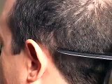 HAIR TRANSPLANT DONOR CLOSURE, TRICHOPHYTIC 2 DALLAS TEXAS