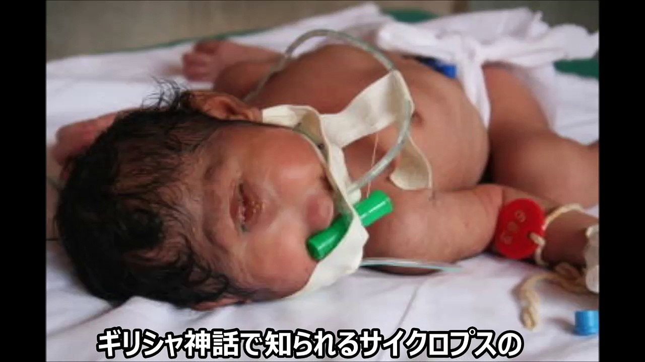 【閲覧注意】サイクロプス 目が一つしかない奇病