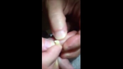 Big Blackhead Popped on Toe!