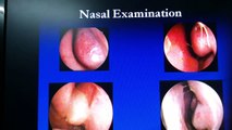 Nasal Allergy-Allergic Rhinitis-Treatment : Dr.K.O.Paulose FRCS