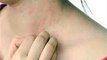 Las alergias en la piel