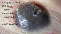 Moles and Melanoma