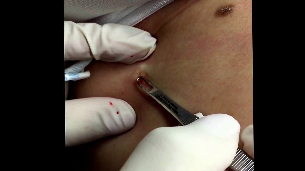 Just a couple of blackheads but one's a beauty! For medical education- NSFE.