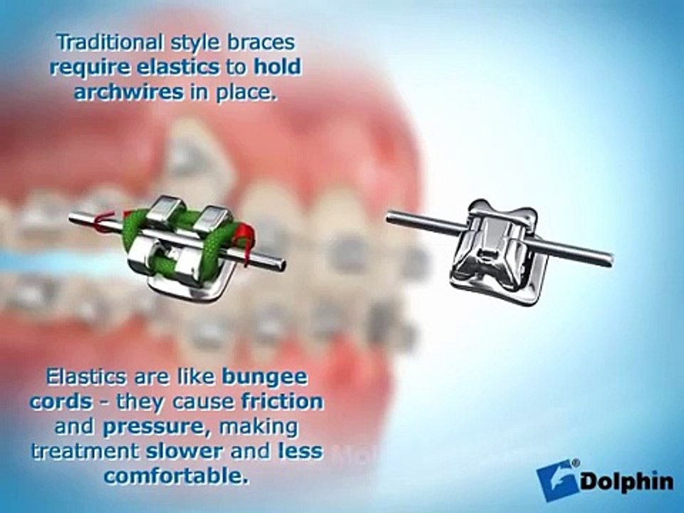 Appareil dentaire - méthode de fonctionnement de l'appareil dentaire