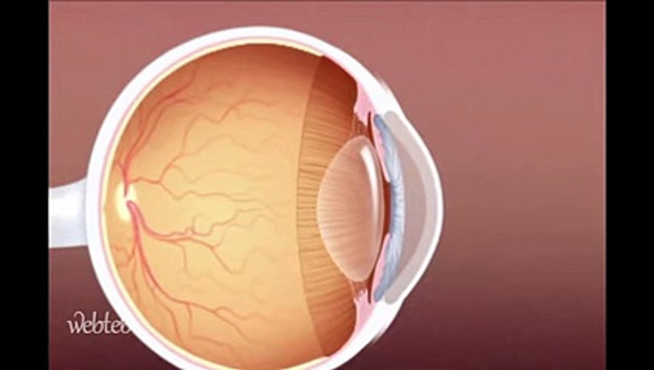 عملية الليزك - المركز الروسي لطب العيون LASIK