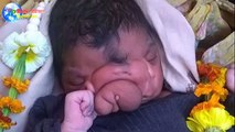 Girl born with 'elephant trunk' deformity is worshipped like a god in India