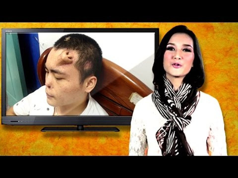 OMG! Man Grows Nose On Forehead