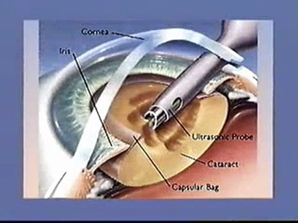cataract surgery