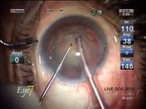 Microphaco small incision cataract surgery (MICS) with Alcon multifocal IOL at Eye7, Delhi, India