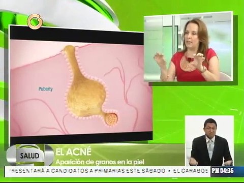 El acné puede generar problemas de depresión y ansiedad