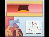 NEJM Procedure: Primary PCI for Myocardial Infarction with ST-Segmented Elevation