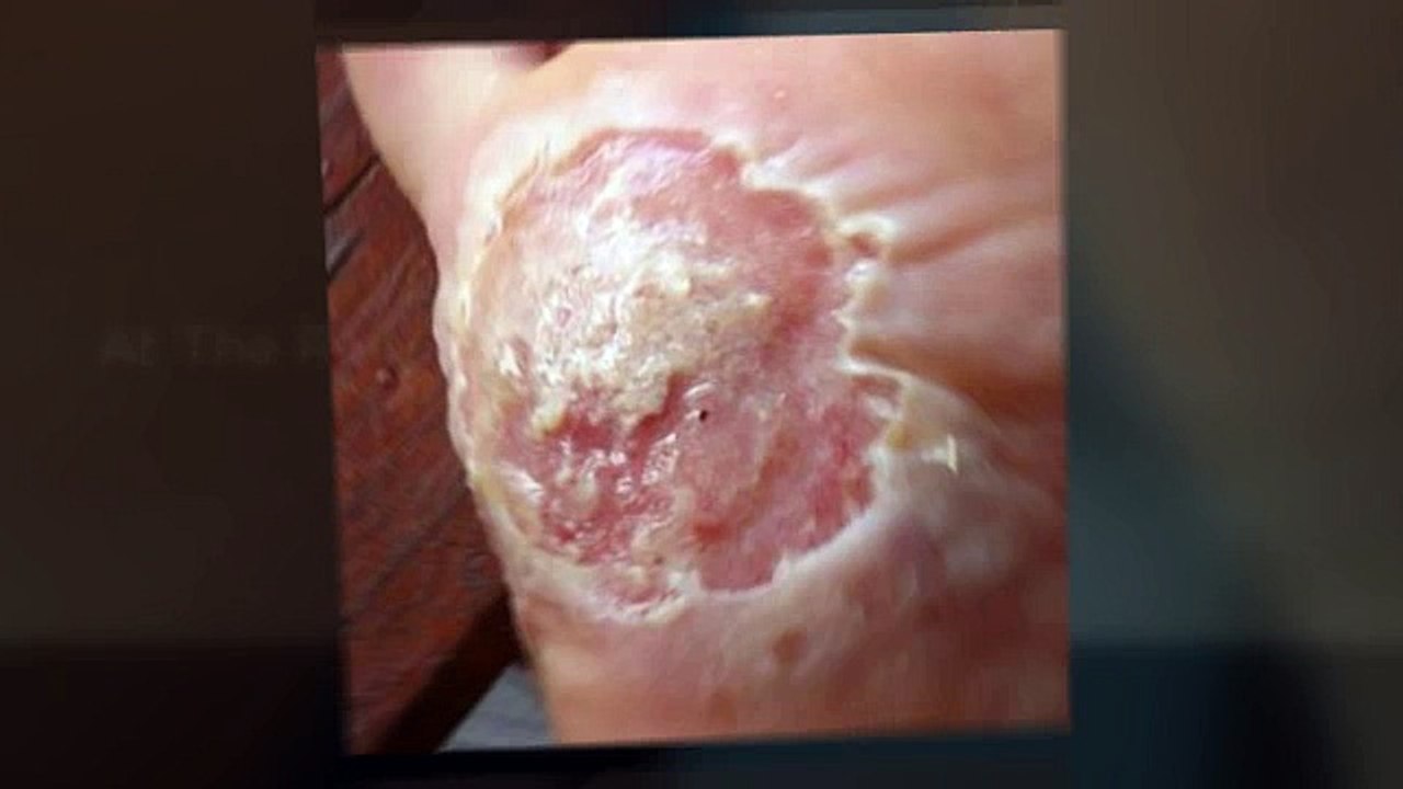 Cure For Warts
