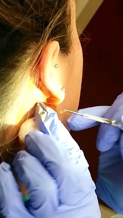 Infected Lymph Node with Abcess Drained