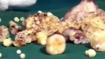 WATCH: Indian Boy With Mouth Full Of Teeth | India Doctors Remove 232 Teeth From Boy's Mouth