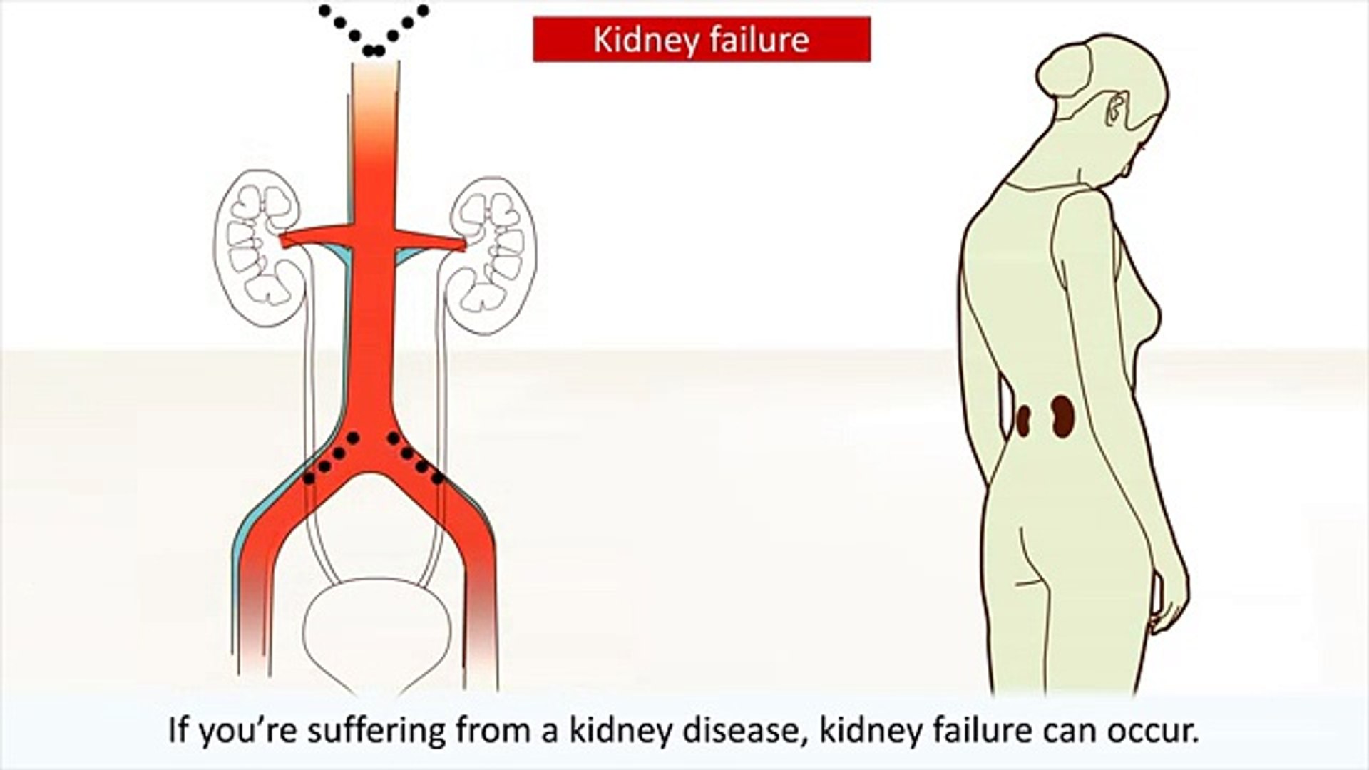 ⁣renal failure-syptoms and treatment