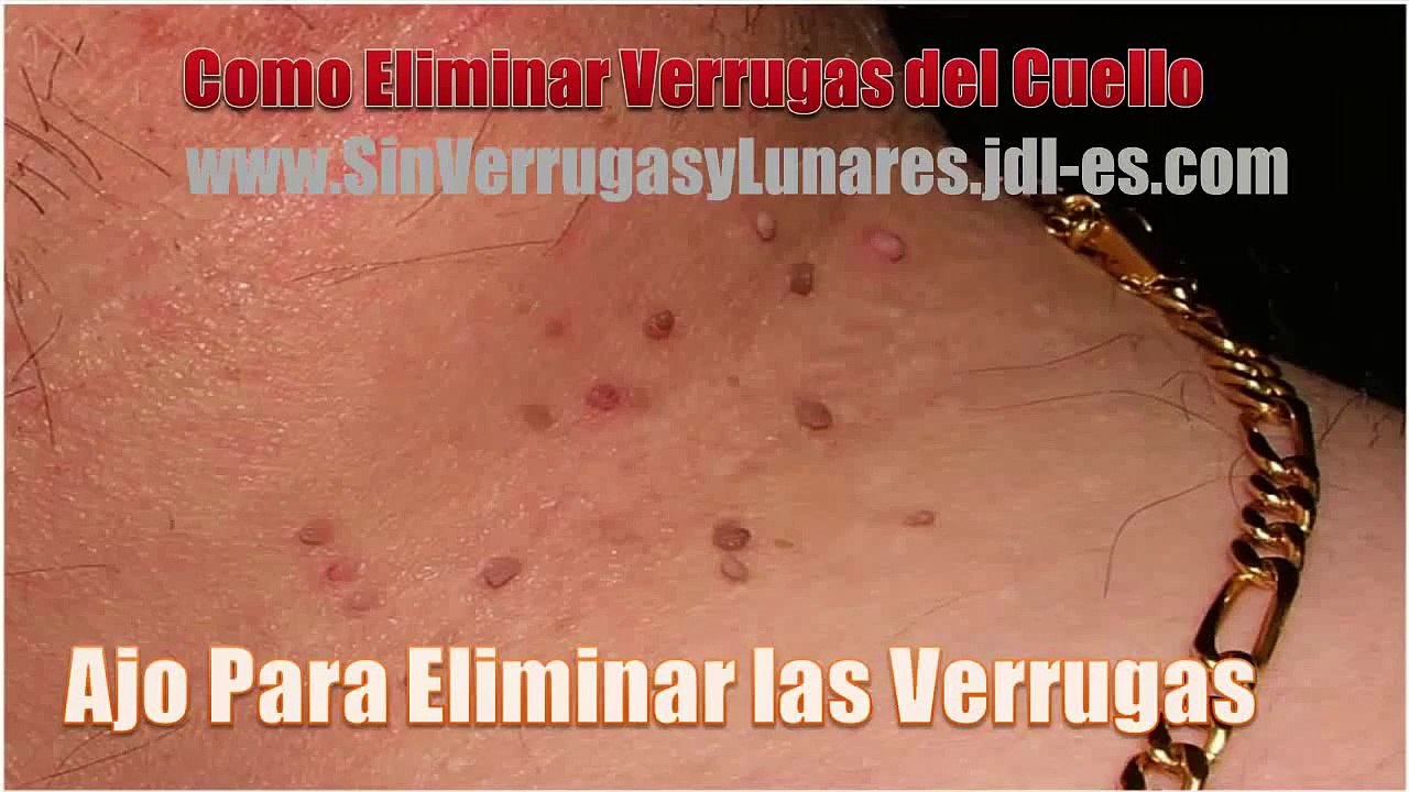 VERRUGAS EN EL CUELLO Y AXILAS