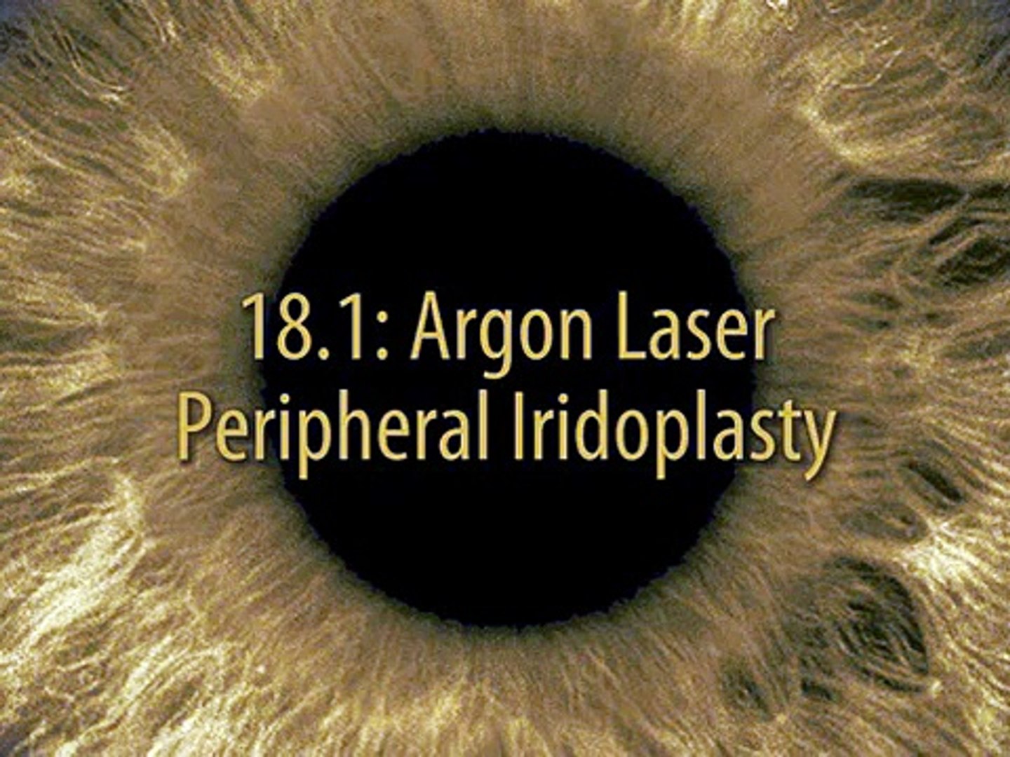 Argon laser peripheral iridoplasty - video Dailymotion