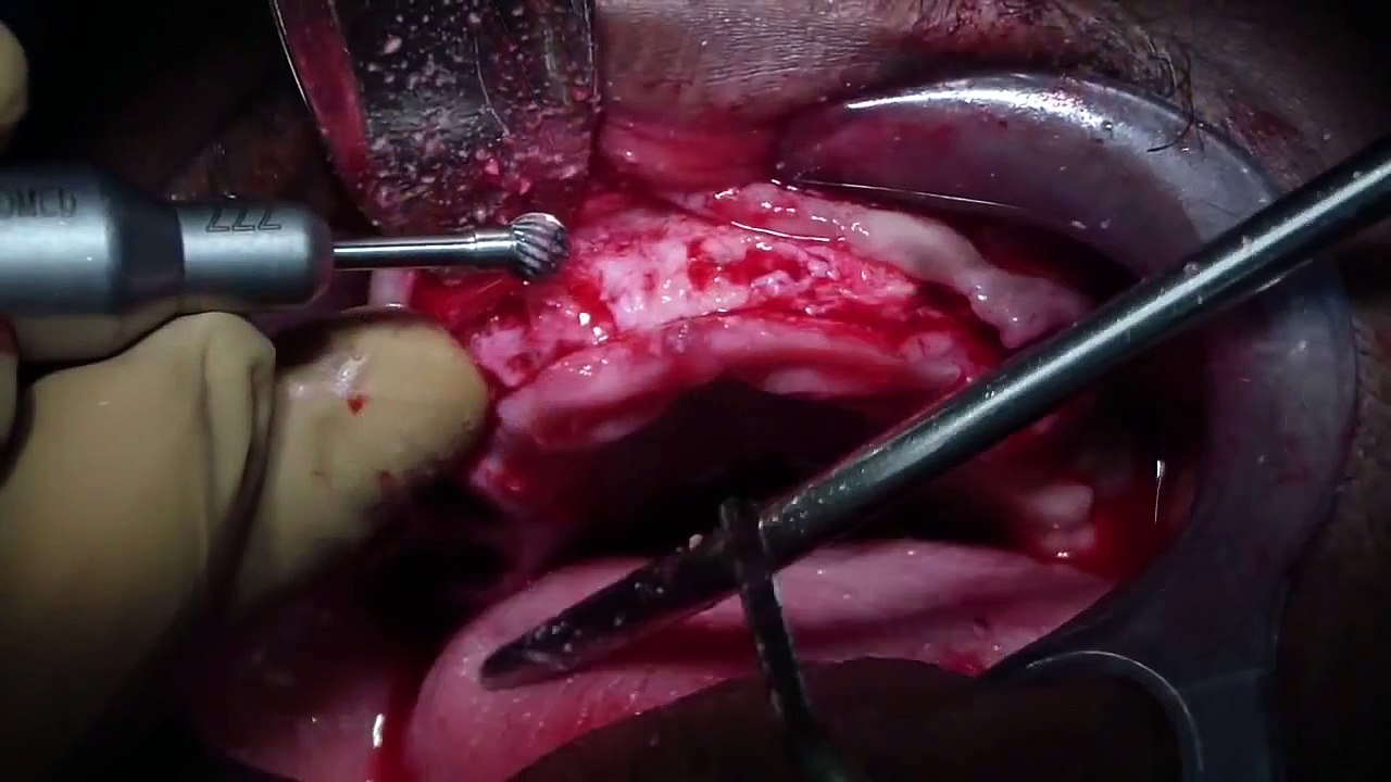 Alveoloplasty - Immediate Denture