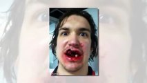Hockey player takes puck to the face and loses 10 teeth