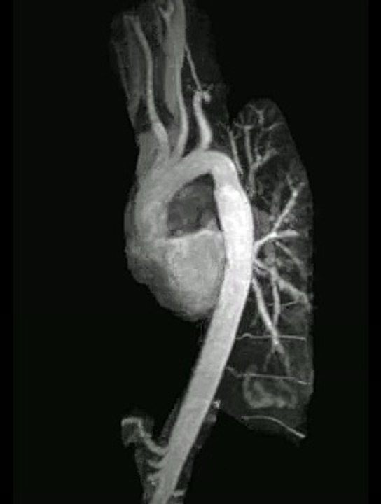 Cardiac mri - aorta angiogram with coarctation