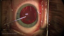 Pediatric Cataract with Posterior Capsulorhexis and Posterior Optic Capture