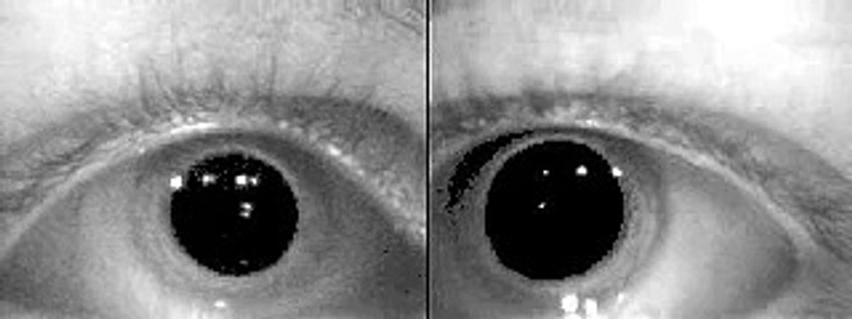 Vertical Nystagmus