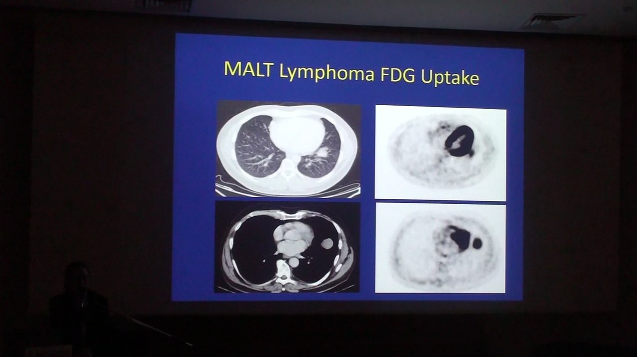 Pulmonary Proliferative Disorders - Sivan Lieberman