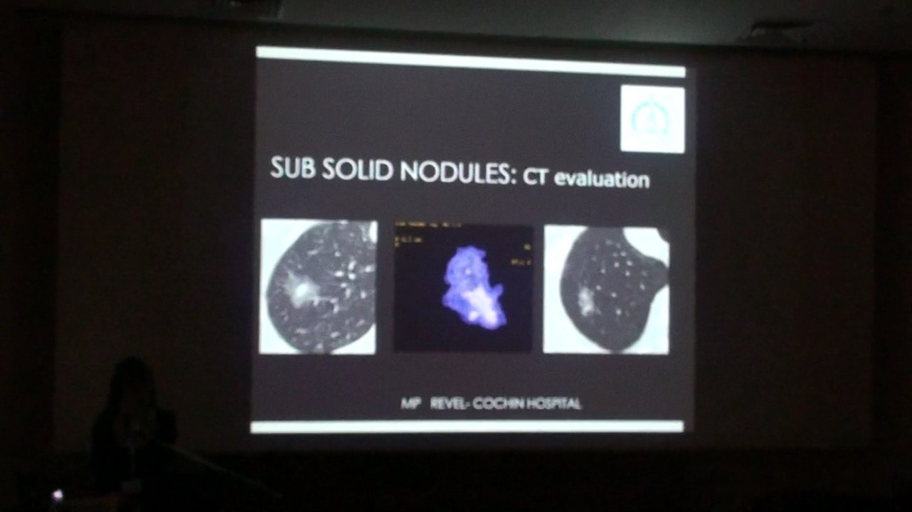 Sub Solid Nodules CT evalution - Marie Pierre Revel