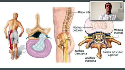 Ejercicios complejos para pinzamiento/hernia de disco