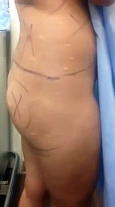 Shape of buttocks is affected by location of hip joint