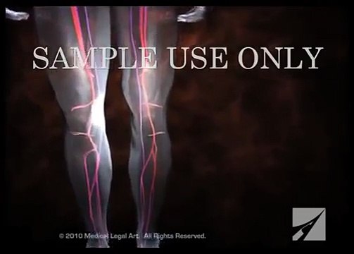 Deep Vein Thrombosis (DVT) and Pulmonary Embolism