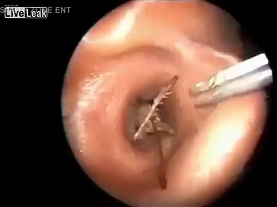 Medicos tiram bicho enorme do ouvido do paciente