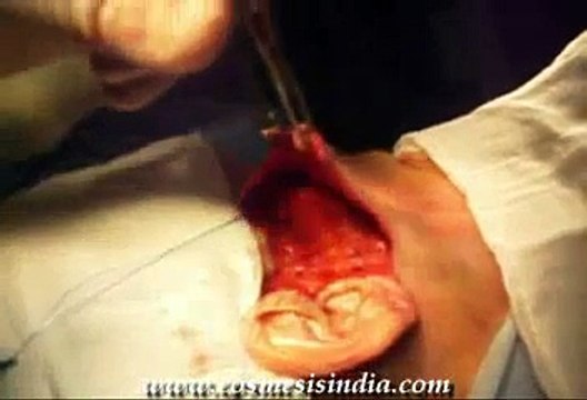 Cosmetic Surgery in India - Dr.Surindher - Face lift ( MACS lift)