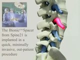 New treatment of Lumbar Spinal Stenosis