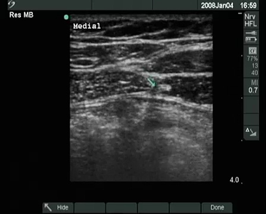 Ultrasound view of the abdominal wall