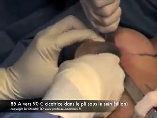 augmentation mammaire par le sillon