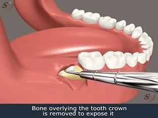 Impacted lower 3rd Molar Extraction