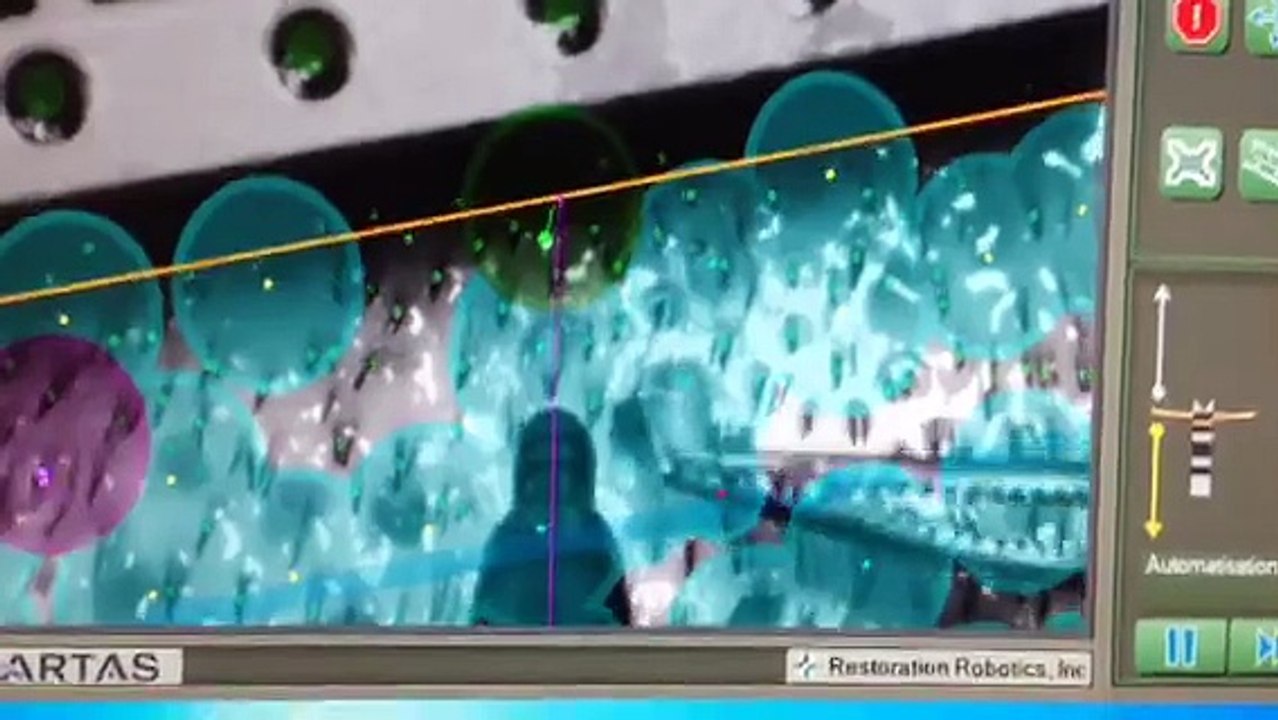 Présentation de la sélection des implants capillaire par le Robot Artas - The Clinic Paris