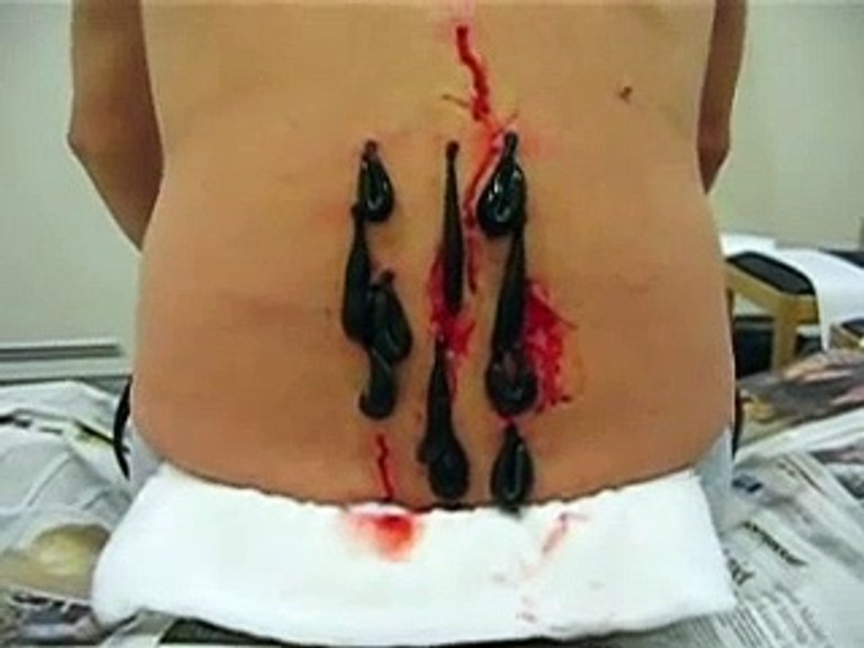 Therapy with leeches/Blutegel/bloedzuigers (Belgium) (12)