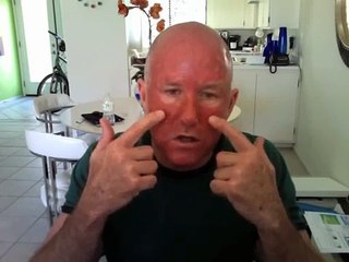 Levulan PDT Aug 21, day 4 after treatment