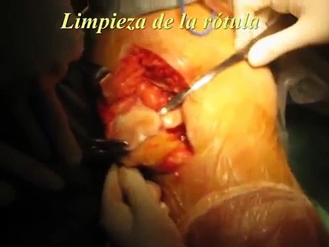 Protesis total de rodilla hibrida - cirugia abierta