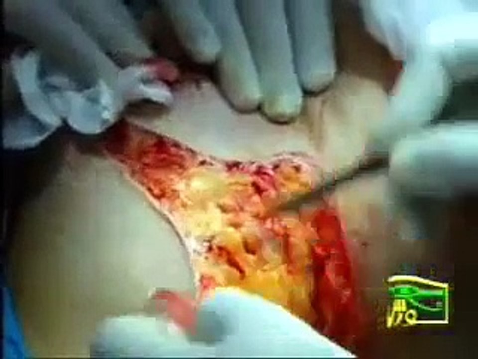 modified radical mastectomy