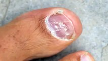How to Skip Laser Toenail Fungus Removal and Treat a Tough Toenail Fungus From Home...