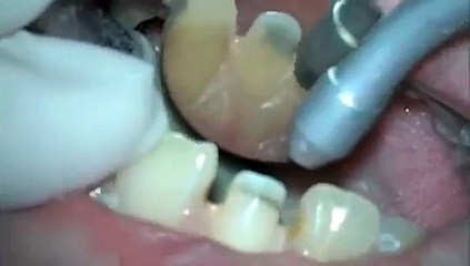 Tooth preparation for All ceramic crown... طربوش الأسنان