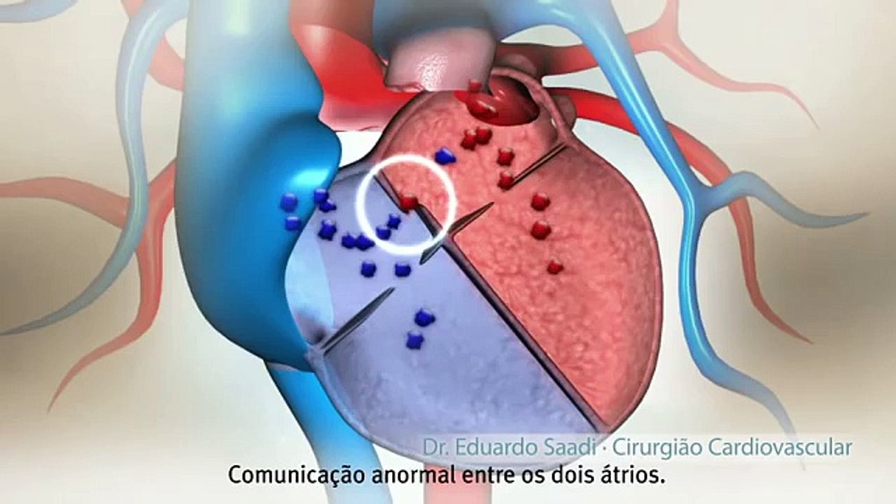 Fechamento de Forame Oval Patente- Comunicação Interatrial