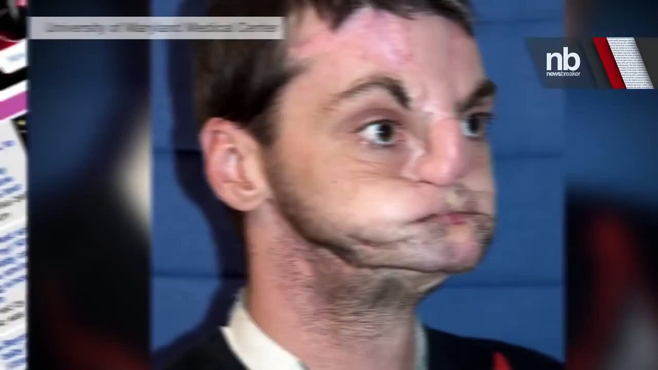 SAVING FACE: Historic Face Transplant Allows Disfigured Gunshot Victim New Life