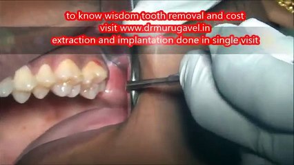 Upper Wisdom tooth-Surgical removal in Best Dental center,Chennai.