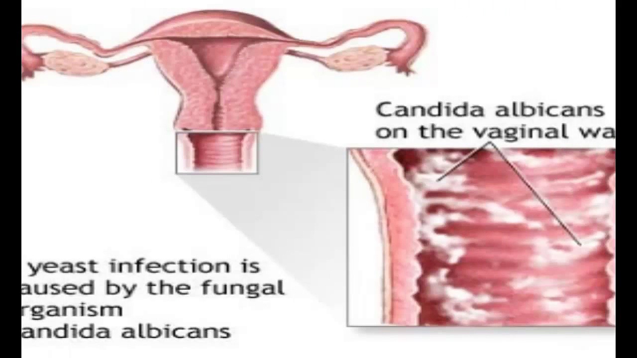 Yeast Infection Symptoms