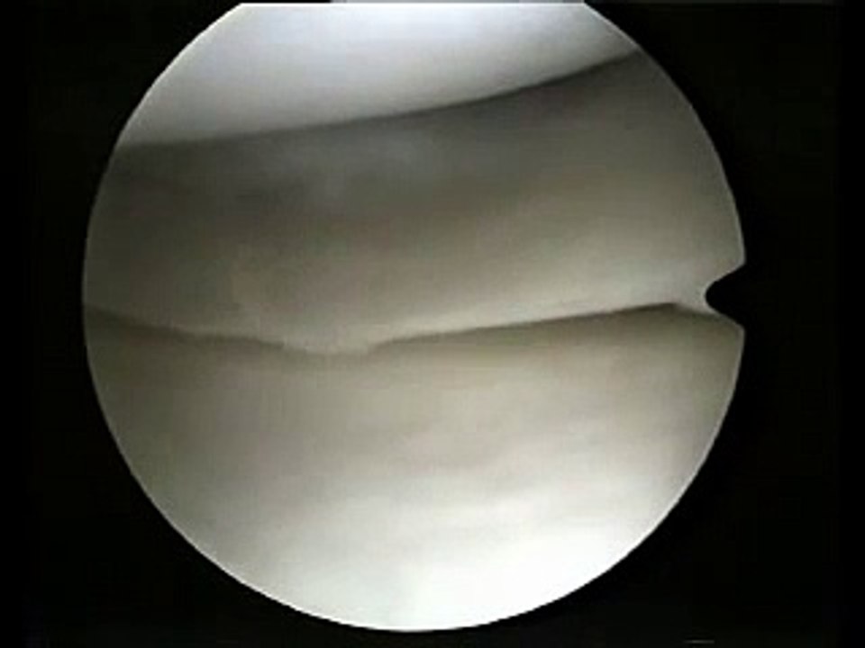 Meniskus OP - Meniscus Surgery